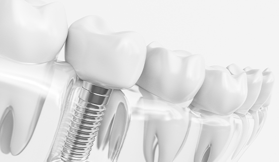 Animated dental implant in the jaw replacing a lower tooth