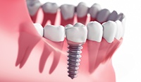 Animated dental implant with crown replacing a missing tooth