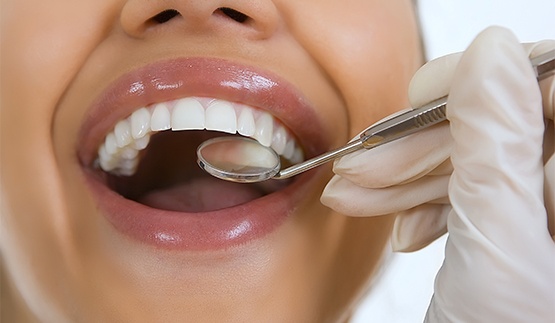 Close up of a dental mirror in a person's smile