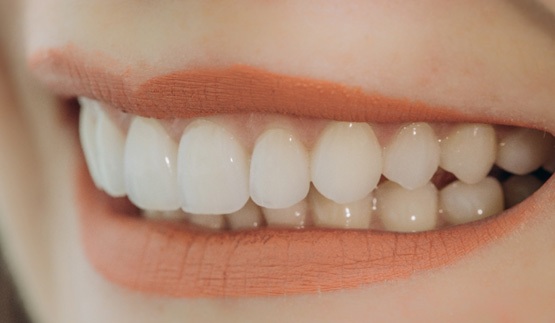 Veneers in Collinsville  