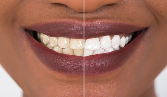 Patient's smile before and after teeth whitening