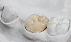 dental crown from dentist in Collinsville
